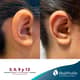 Slider image (10) Dra. Renata Cardenas-Aesthetic & Fuctional Rhinoplasty